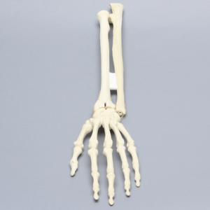 Hand and Wrist with Four-Part Fracture with Displacement, Foam Cortical