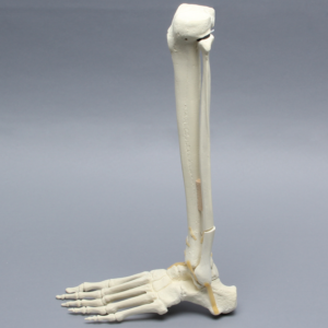 Foot and Ankle with Tibial Four-Part Pilon and Fibular Oblique Fractures