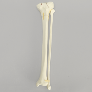 Tibia with Bicondylar and Transverse Fractures and Intact Fibula