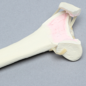 Radius with Fracture for Volar Plate, Foam Cortical