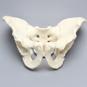 Pelvis with Global and Rim Defects, Full Male, Foam Cortical