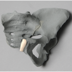 Pelvis, Female Partial, Radiopaque