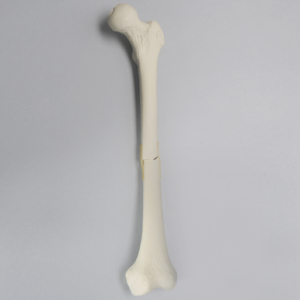 Femur with Light Density Cancellous and Fracture