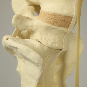 Spine, Lumbar, with L5-Sacrum Grade II Spondylolisthesis