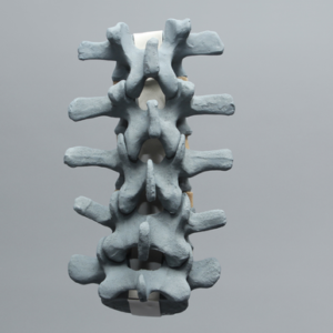 Spine, Lumbar Vertebrae, L1-L5, Radiopaque
