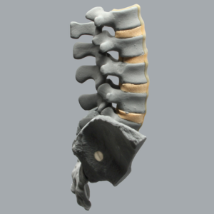 Spine, Lumbar, Bilateral Iliac Crests, Radiopaque