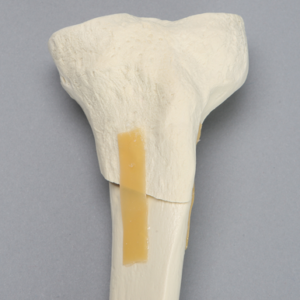 Tibia with Oblique Fracture and Hollow Core
