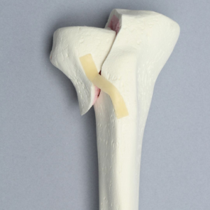 Tibia with Condylar Fracture