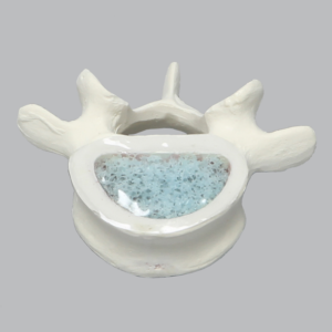 Vertebra, L5, Osteoporotic with Window, Foam Cortical