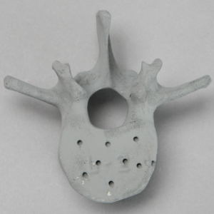 Vertebra, L2, Osteoporotic, Radiopaque