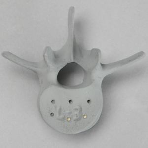 Vertebra, L3, Osteoporotic, Radiopaque