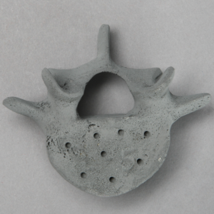 Vertebra, L5, Osteoporotic, Radiopaque