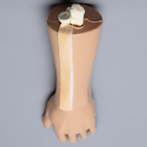 Wrist with Replaceable Fractured Radius, Encased