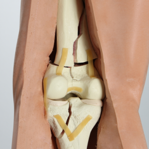 Knee with Fractures, Encased