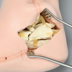 Foot and Ankle with Talar Neck and Six-Part Calcaneal Fracture, Encased