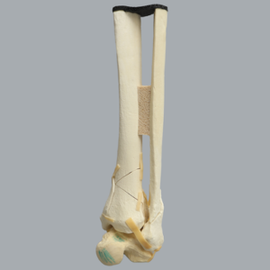 Ankle with Pilon and Oblique Fractures