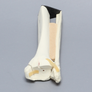 Ankle with Malleolar Fractures