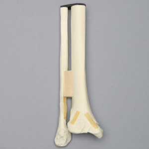 Ankle with Medial and Posterior Malleolar, and Oblique Fibular Fractures