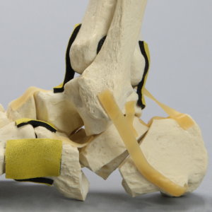 Foot and Ankle with Three-Part Calcaneal Fracture