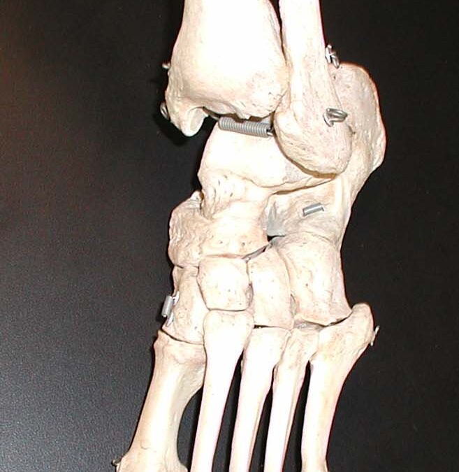 Clubfoot – Ponseti