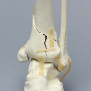 Foot and Ankle with Pilon Fracture