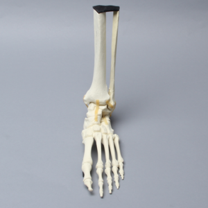 Foot and Ankle with Calcaneal Fracture