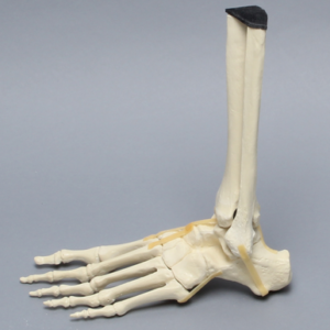Foot and Ankle with Lisfranc Fracture