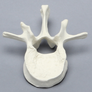 Vertebra, L1, Fractured, Solid Foam