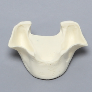 Maxilla, Edentulous