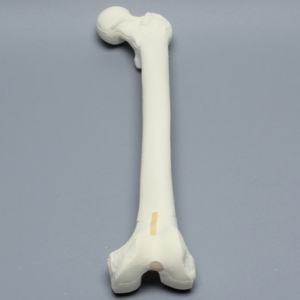 Femur with Supracondylar Fracture