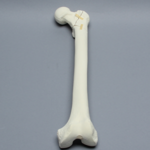 Femur with Intertrochanteric Three-Part Fracture