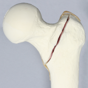 Femur with Intertrochanteric Fracture and Small Fragment