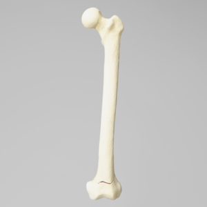 Femur with Transverse Fracture and Fragment