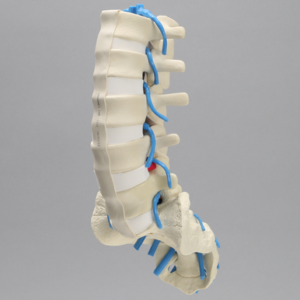 Spine, Lumbar, Herniated Disc, Solid Foam