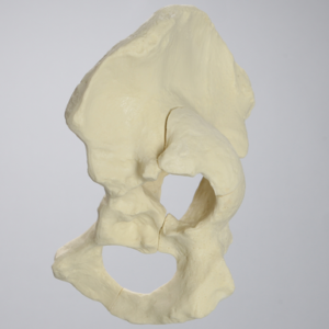 Hemi Pelvis with Severe Deformities, Solid Foam, Left