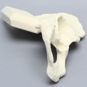 Hemi Pelvis with Dysplasia, Solid Foam, Right