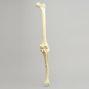 Knee with Bicondylar and Oblique Fractures of the Tibia, Full Length