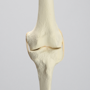 Knee with Three Stretch Tube Ligaments and Narrow Femoral Canal, Full Length