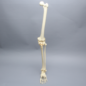 Leg with Plateau Fracture, Full Length