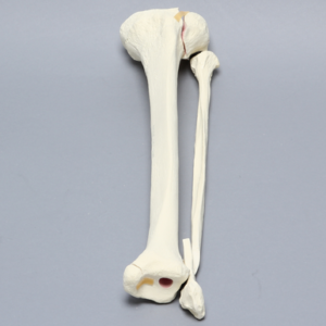 Tibia and Fibula with Condylar, Malleolar, and Oblique Fractures
