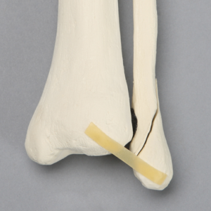 Tibia and Fibula with Oblique Fibular Fracture