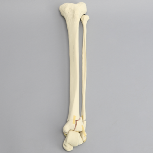 Tibia and Fibula with Pilon and Fractures