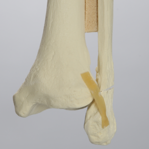 Ankle with Displaced Oblique Fracture