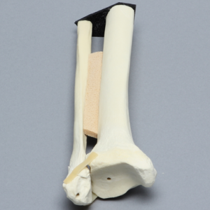 Ankle with Lateral Malleolar Fracture