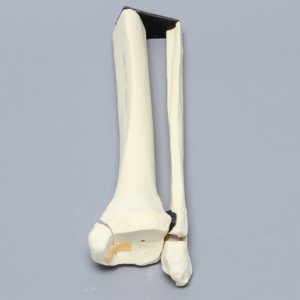 Ankle with Malleolar and Spiral Fractures