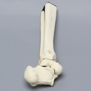 Ankle with Supination-Adduction Fracture