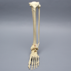 Foot and Ankle with Articulation and Tibial Pilon and Transverse Fibular Fractures