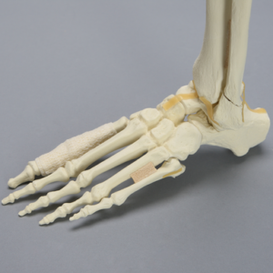 Foot and Ankle with Fractures and Articulation at IP Joint