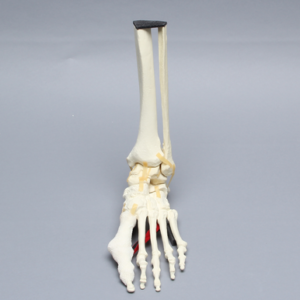 Foot and Ankle with Five-Part Talar Fracture, Bunions, and Hammertoes