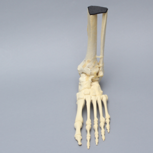 Foot and Ankle with Tibial Pilon and Fibular Oblique Fractures and Talar Rotation